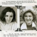 18 pacientů, kteří podstoupili lobotomii. Fotografie před a po tomto lékařském zákroku - lobotomy-before-and-after-12