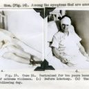 18 pacientů, kteří podstoupili lobotomii. Fotografie před a po tomto lékařském zákroku - lobotomy-before-and-after-16