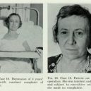 18 pacientů, kteří podstoupili lobotomii. Fotografie před a po tomto lékařském zákroku - lobotomy-before-and-after-18