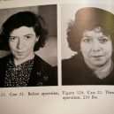 18 pacientů, kteří podstoupili lobotomii. Fotografie před a po tomto lékařském zákroku - lobotomy-before-and-after-2