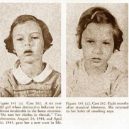 18 pacientů, kteří podstoupili lobotomii. Fotografie před a po tomto lékařském zákroku - lobotomy-before-and-after-8