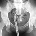 15 opravdu bizarních rentgenových snímků - weird-x-rays-candy-cane
