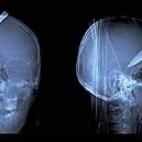 15 opravdu bizarních rentgenových snímků - weird-x-rays-knife-in-head