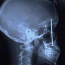 15 opravdu bizarních rentgenových snímků - weird-x-rays-nail-in-face