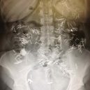 15 opravdu bizarních rentgenových snímků - weird-x-rays-nails