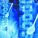15 opravdu bizarních rentgenových snímků - weird-x-rays-spoon